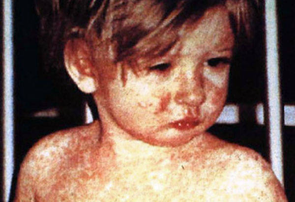Measles is most dangerous for young children. (Wikicommons media)