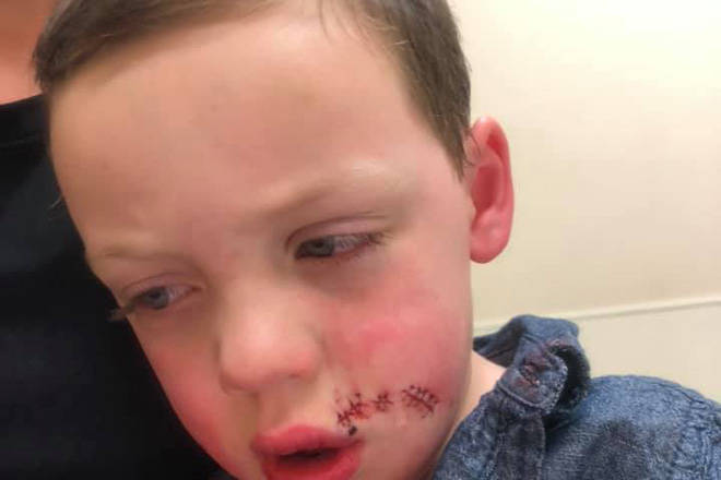 Gavin Lightfoot, 3, with family ties to the North Okanagan, suffered a 15-stitch gash to the face after being bit by a dog at a Calgary house birthday party. (Facebook photo)