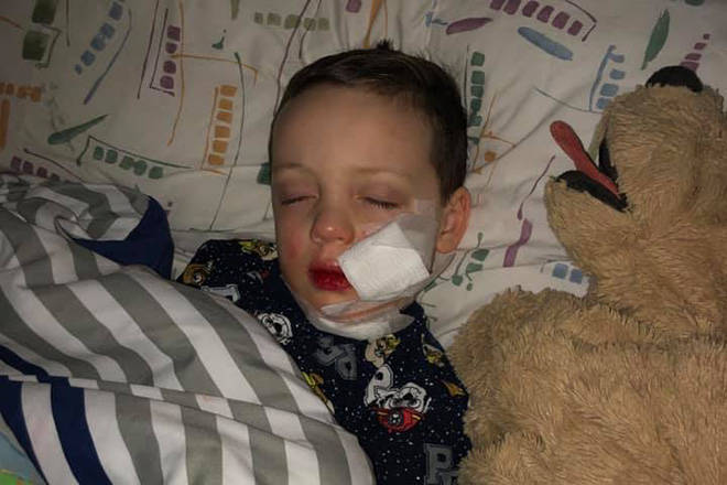 Gavin Lightfoot, 3, with family ties to the North Okanagan, suffered a 15-stitch gash to the face after being bit by a dog at a Calgary house birthday party. (Facebook photo)